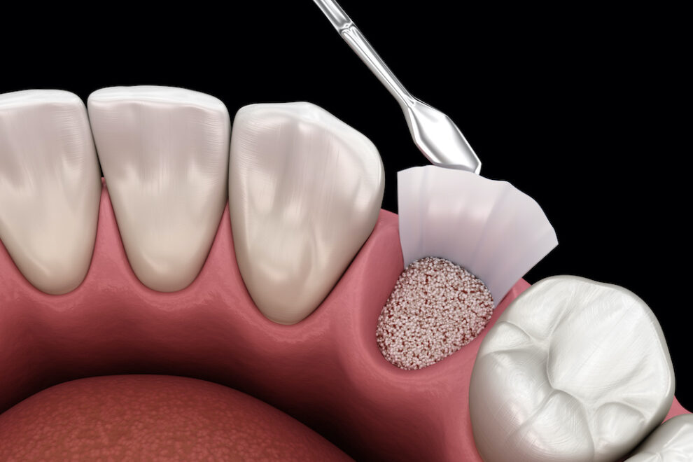 Augmentation Surgery – Adding bone after tooth extraction. 3D illustration