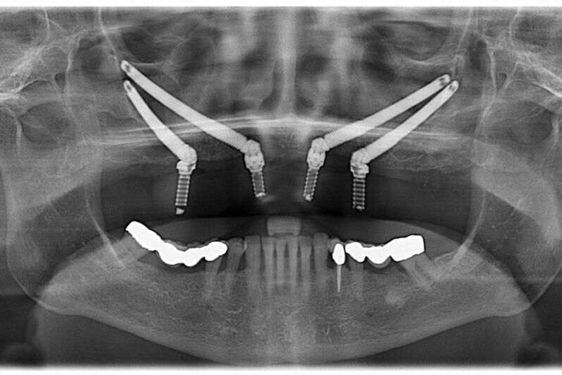 zygomatic-dental-implants-1024×531